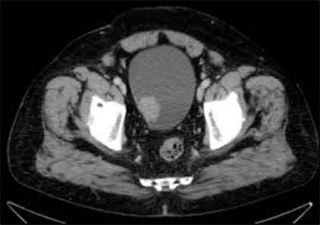 CT showing bladder with bladder cancer growing inwards from bladder wall