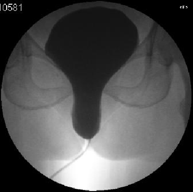BladderProlapseXray