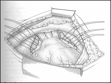 Colposuspension