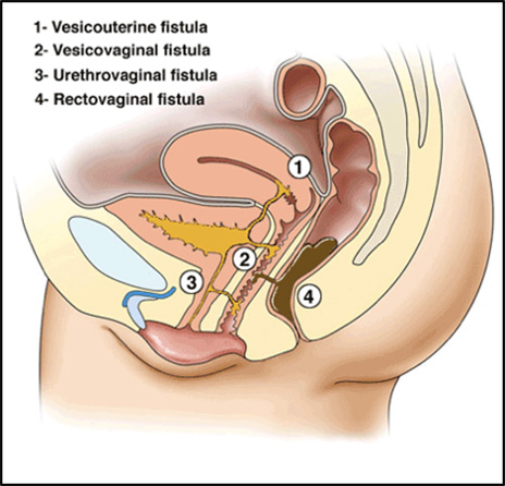 Fistula