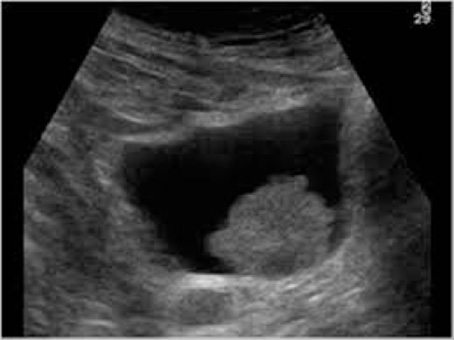 Ultrasound showing bladder in black with bladder cancer growing inwards from bladder wall