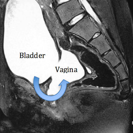 Fig 2 - MRI - Water (urine) shows up white. Bladder and the vagina behind both filled with urine