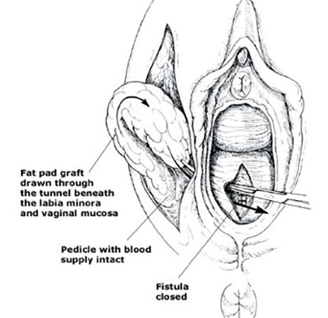 Vaginal Repair