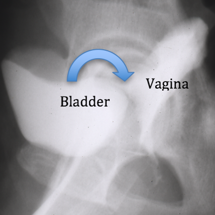 Fig 1 - Cystogram - X-ray showing dye leaking from bladder into vagina